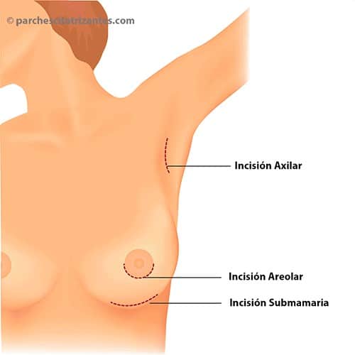 imagen de ilustra las diferentes incisiones para el aumento de pecho Las diferentes cicatrices por aumento de pecho: Cicatriz Submamaria, Cicatriz Axilar, Cicatriz Areolar o Periareolar