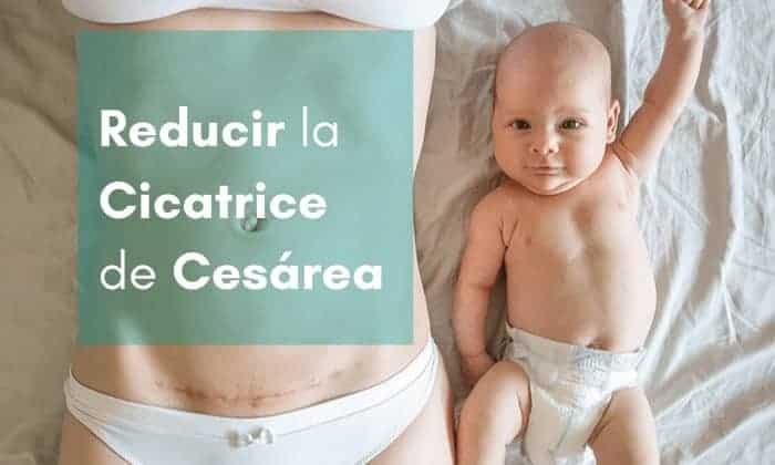Parches cicatrizantes para cicatrices de cesárea Parches para Cesárea: mejores reductores de cicatrices de cesárea
